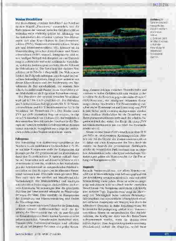 Vorschauseite 4: Gefäßverschlüsse der Netzhaut Eine interdisziplinäre Herausforderung