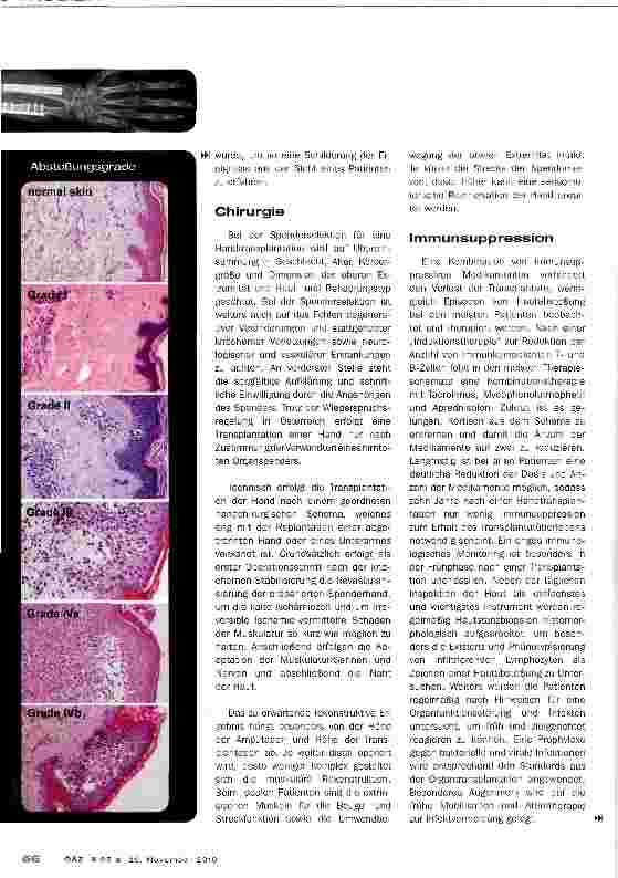 Vorschauseite 3: Handtransplantation