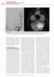 Vorschauseite 3: Intensivtherapie des ischämischen Schlaganfalls