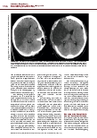 Vorschauseite 5: Intensivtherapie des ischämischen Schlaganfalls