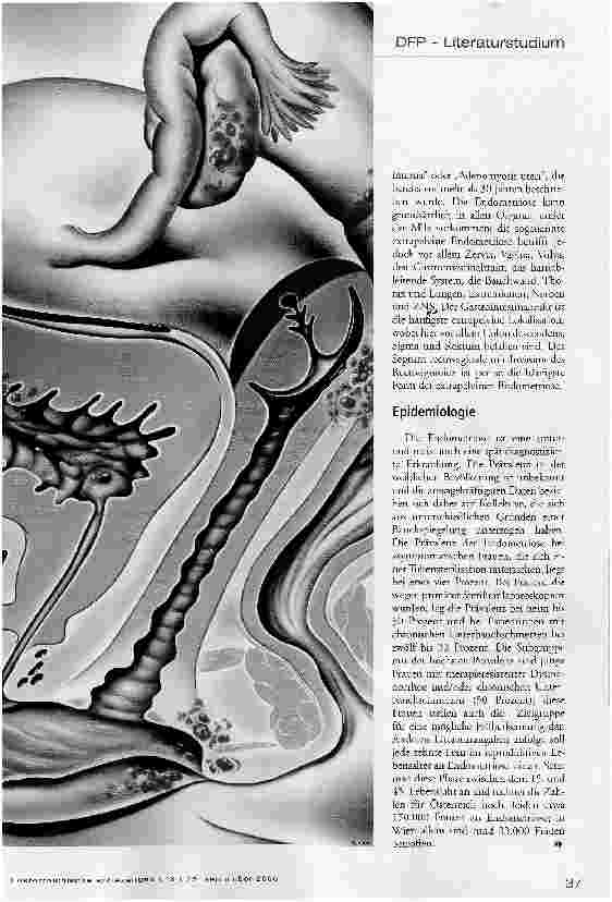 Vorschauseite 2: Endometriose