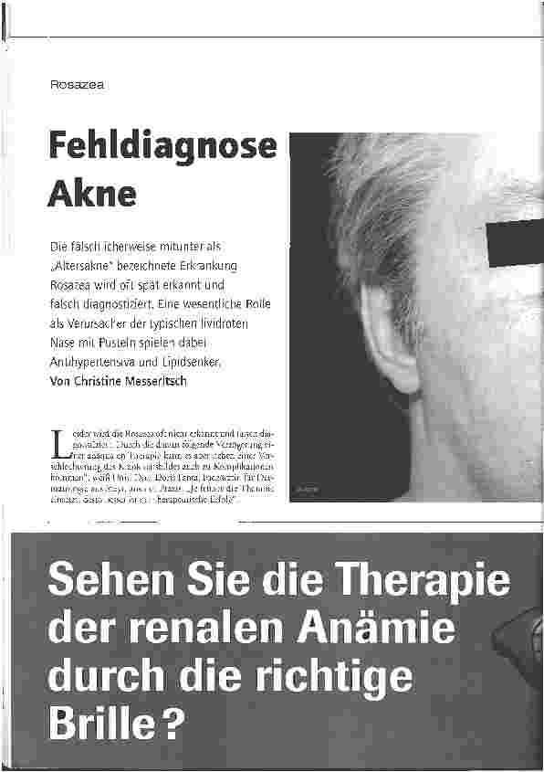 Vorschauseite 1: Rosazea - Fehldiagnose Akne
