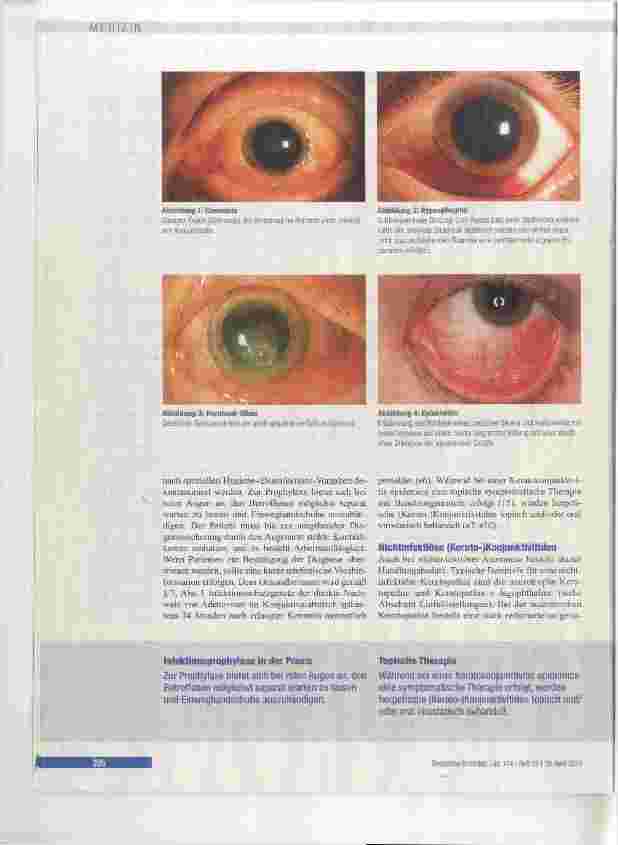 Vorschauseite 5: Rotes Auge Leitfaden für den Nicht-Ophthalmologen