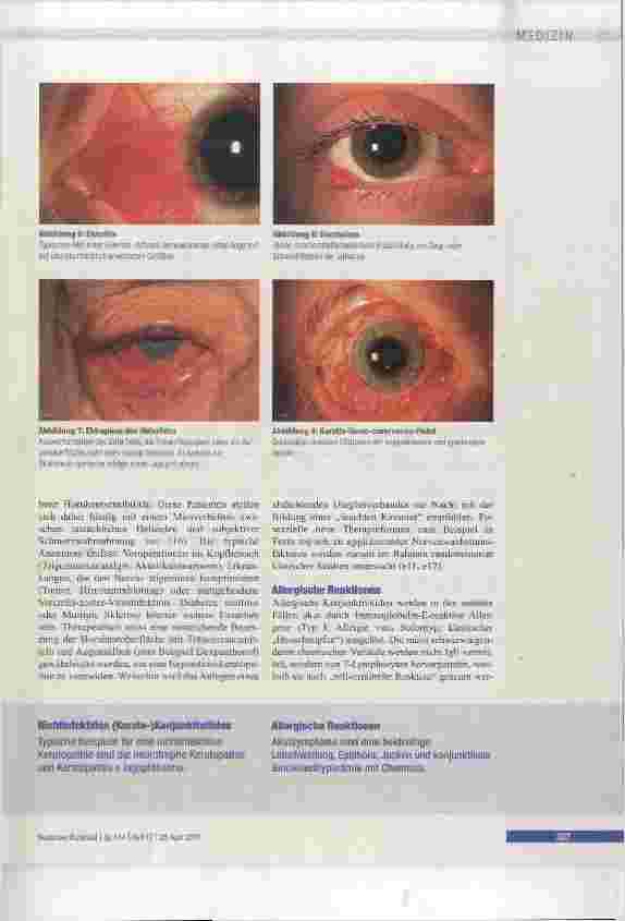 Vorschauseite 6: Rotes Auge Leitfaden für den Nicht-Ophthalmologen
