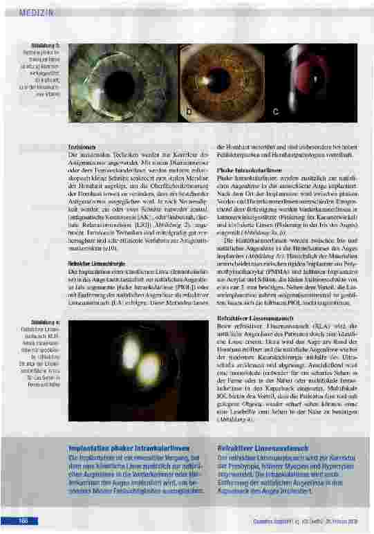 Vorschauseite 4: Basiswissen refraktive Chirurgie