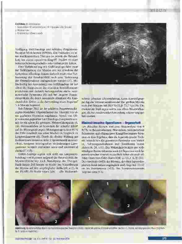 Vorschauseite 3: Konservative, operative und interventioneile Therapieoptionen uteriner Myome