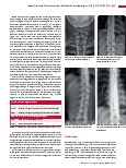 Vorschauseite 2: Anomalien und Normvarianten: Skelettale Veränderungen 3.16 Stummelrippen der Wirbelsäule