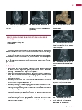 Vorschauseite 2: Anomalien und Normvarianten: Skelettale Veränderungen 3.24 Akzessoria des Sprunggelenks – Os trigonum