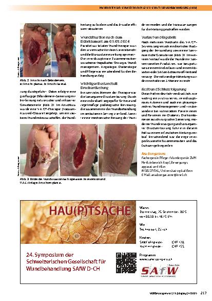 Vorschauseite 2: Diabetisches Fußsyndrom mit Wundinfektion unter V. A. C. -Therapie