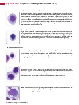 Vorschauseite 3: Dysplastische Veränderungen der Hämatopoese (Teil 3) Dyserythropoese
