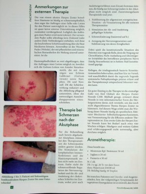Vorschauseite 6: Schmerzhafte Blasen Herpes Zoster in der Traditionellen Europäischen Naturj Heilkunde