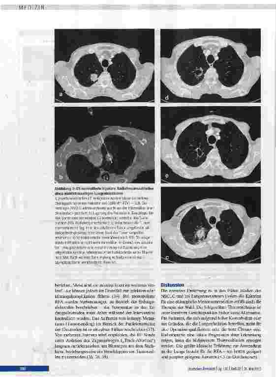 Vorschauseite 5: Thermoablation maligner Lungentumoren