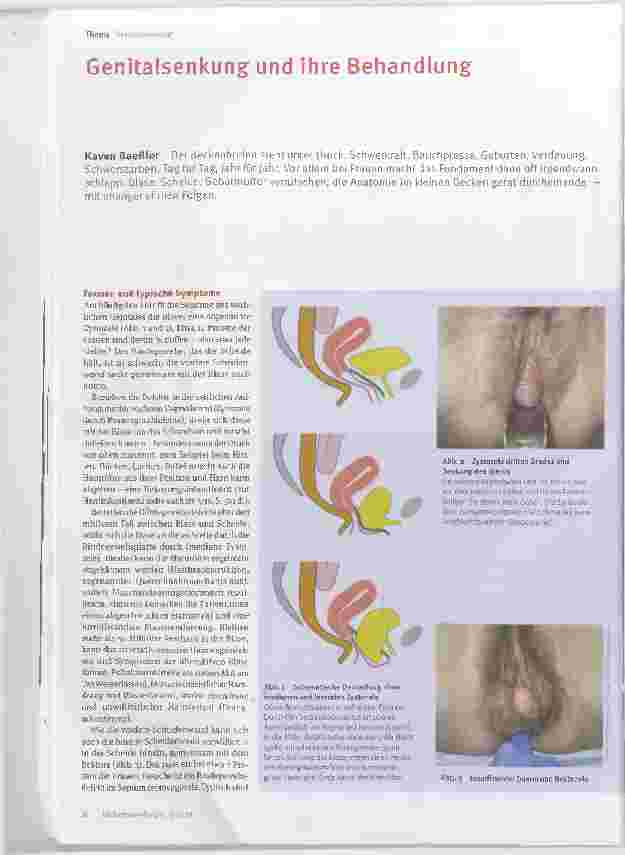 Vorschauseite 1: Genital Senkung und ihre Behandlung
