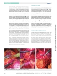 Vorschauseite 5: Handassistierte retroperitoneoskopische Nephrektomie zur Lebendspende