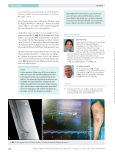 Vorschauseite 4: MILLER-Banding: Behandlung des Steal-Syndroms nach AV-Shuntanlage