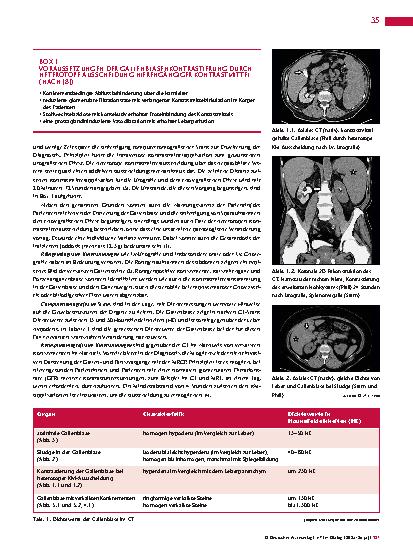 Vorschauseite 2: Anomalien und Normvarianten – Interne Veränderungen 2. 30: Heterotope Ausscheidung nierengängiger Kontrastmittel
