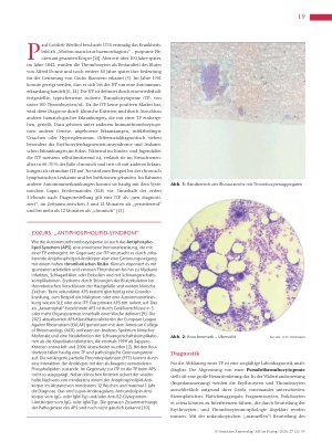 Vorschauseite 2: Immunthrombozytopenie: Hinweise im Labor erkennen und interpretieren
