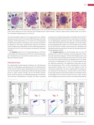 Vorschauseite 4: Immunthrombozytopenie: Hinweise im Labor erkennen und interpretieren