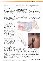 Vorschauseite 2: Fußchirurgie bei Diabetischem Fußsyndrom (DFS) - ausgewählte Konzepte der inneren Entlastung