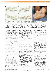 Vorschauseite 6: Fußchirurgie bei Diabetischem Fußsyndrom (DFS) - ausgewählte Konzepte der inneren Entlastung