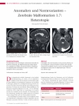 Vorschauseite 1: Anomalien und Normvarianten - Zerebrale Malformation 1.7: Heterotopie