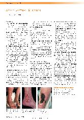 Vorschauseite 1: Arterio-venöses Ulcus cruris