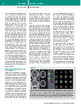 Vorschauseite 4: Anästhesiologische Versorgung von Schlaganfallpatienten während endovaskulärer Thrombektomie: Praxis und Stand der Wissenschaft