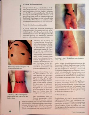 Vorschauseite 3: Sauger im Einsatz Blutegeltherapie bei Arthrose