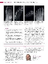 Vorschauseite 3: Anomalien und Normvarianten: Skelettale Veränderungen 3. 31 - Varianz der Sesambeine des Vorfußes