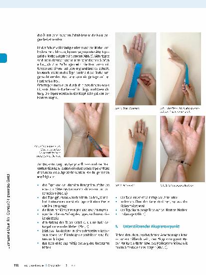Vorschauseite 5: Karpaltunnelsyndrom und die gezielte Handund Narbentherapeutische Behandlung