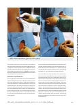 Vorschauseite 5: Axilläre Plexusanästhesie und Spinalanästhesie