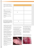 Vorschauseite 2: Skin Tears – Einrisse fragiler Haut