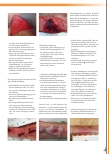 Vorschauseite 3: Skin Tears – Einrisse fragiler Haut