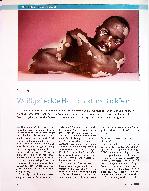 Vorschauseite 1: Vitiligo Weißgefleckte Haut rückt ins Blickfeld
