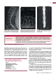 Vorschauseite 3: Anomalien und Normvarianten – Skelettale Veränderungen 3.18 Diastematomyelie