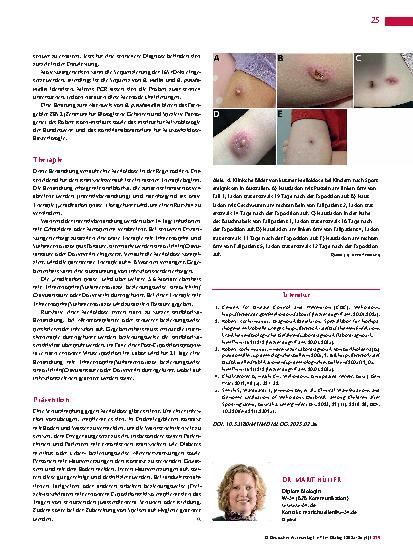Vorschauseite 4: Melioidose – „the great mimicker“