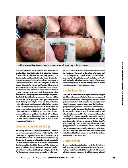 Vorschauseite 2: Wundversorgung bei einem Säugling im ambulanten Setting