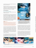Vorschauseite 5: Transkatheter Aortenklappenimplantation - perkutan über die Leiste