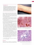 Vorschauseite 4: Schistosomiasis ist eine Tropenkrankheit, die Europa erreicht hat.