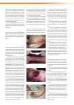 Vorschauseite 2: Graft-versus-Host-Erkrankung (GvHD) nach Stammzelltherapie bei Leukämie