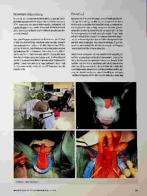 Vorschauseite 3: Penisprothese