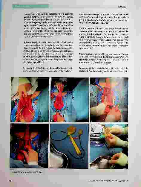 Vorschauseite 4: Penisprothese