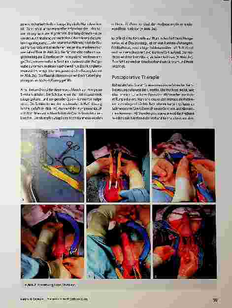 Vorschauseite 5: Penisprothese