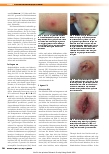Vorschauseite 3: Panton-Valentine-Leukozidin (PVL): Daran denken! Gestörte Wundheilung und prolongierter Verlauf von kutanen Abszessen – ein Staphylokokken-Exotoxin verhindert eine rasche Heilung…
