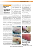 Vorschauseite 6: Panton-Valentine-Leukozidin (PVL): Daran denken! Gestörte Wundheilung und prolongierter Verlauf von kutanen Abszessen – ein Staphylokokken-Exotoxin verhindert eine rasche Heilung…