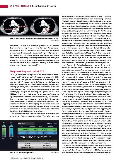 Vorschauseite 3: Erkrankungen der Aorta Krankheitsbilder und CT-Diagnostik