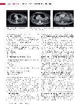 Vorschauseite 3: Thorax-CT: Mammakarzinom als Zufallsbefund