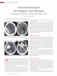 Vorschauseite 1: Herausforderungen bei Diagnose und Therapie Hirnblutungen sind komplex - Innovationen bringen Vorteile