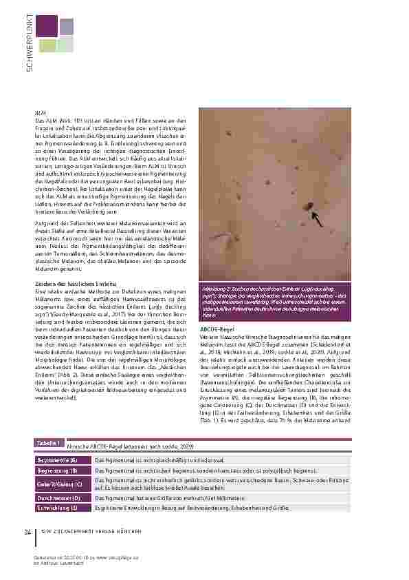 Vorschauseite 3: Klinische Diagnostik des malignen Melanoms