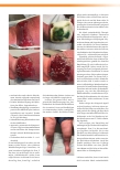 Vorschauseite 2: Antimikrobielle und ganzheitliche Versorgung einer Patientin mit Gamaschenulzera und Lymphödemen